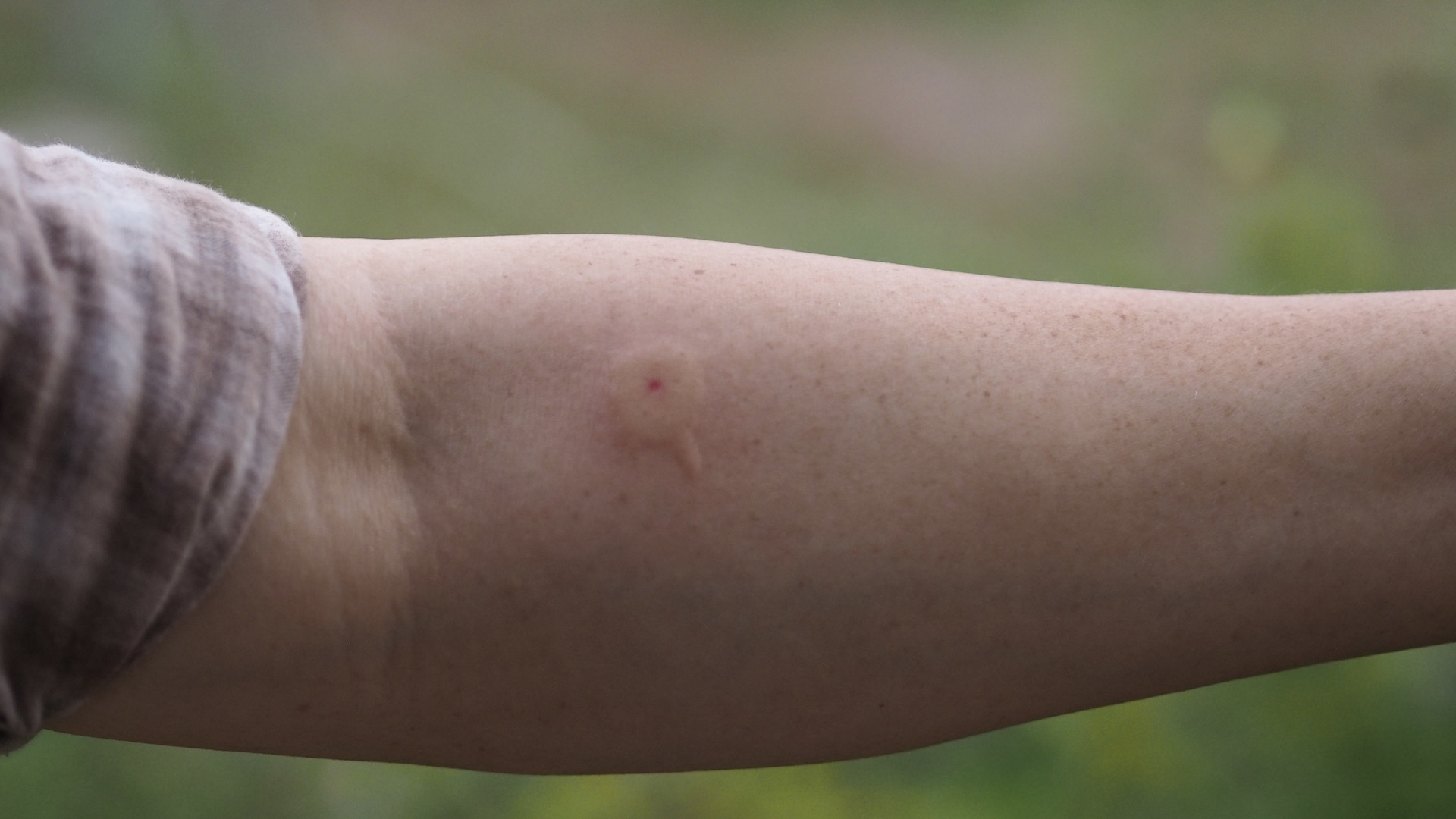picadura de insecto en el brazo de un hombre